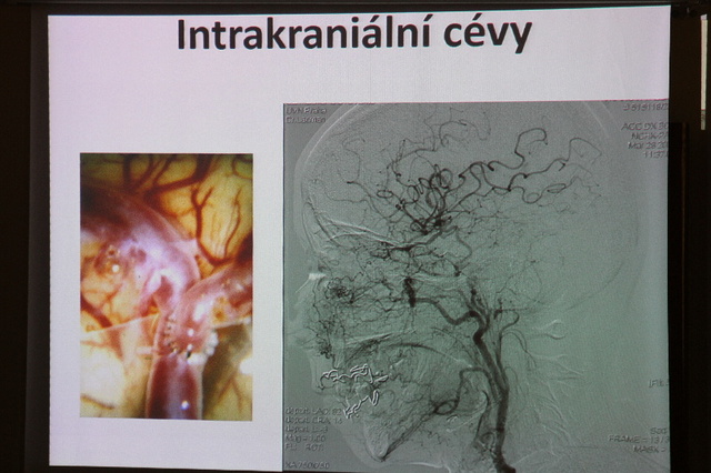 Komplexní cerebrovaskulární centrum ÚVN 04