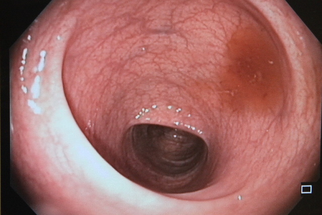 ÚVN - kolonoskopie 08